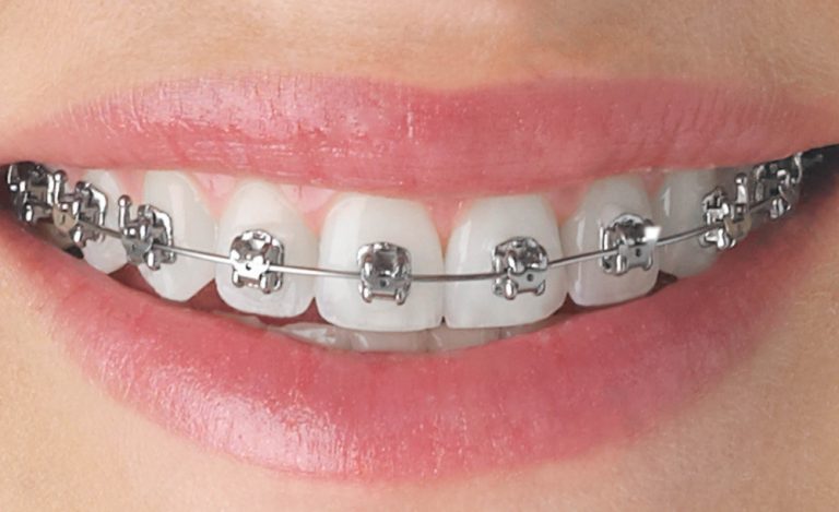 Brackets autoligados 1