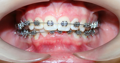 Brackets autoligados 2