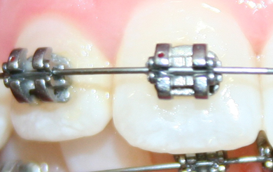 Brackets autoligados 3