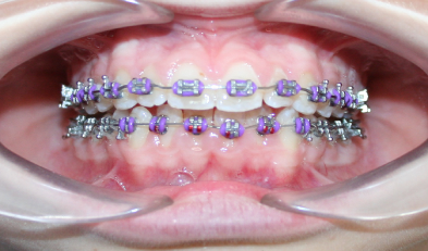 Ortodoncia convencional 3