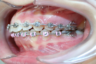 Ortodoncia convencional 4