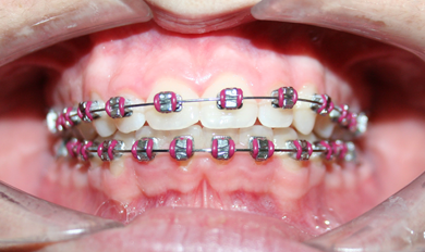 Ortodoncia convencional 5