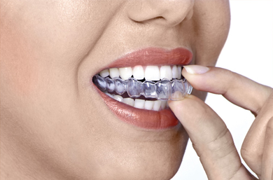 Tratamiento Invisalign 2