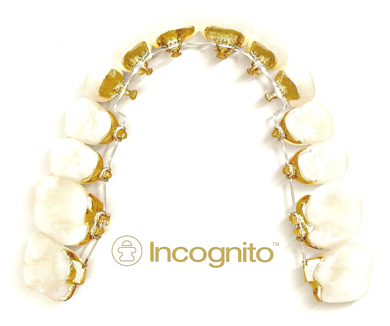 Ortodoncia lingual 1