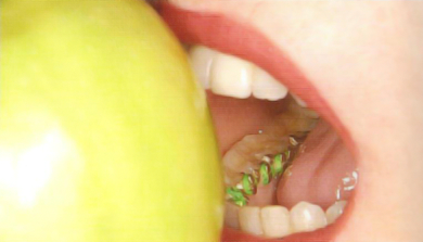 Ortodoncia lingual 2