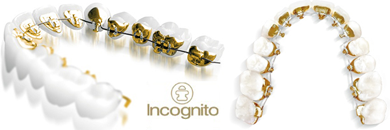 Ortodoncia lingual 3