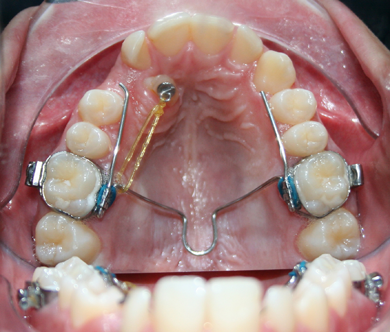 Tracción de dientes incluidos