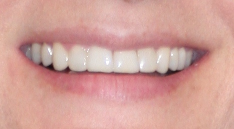 Diseño interdisciplinar de sonrisa 2
