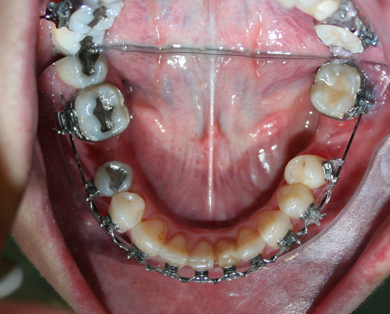 Enderezamiento de molares para implantes