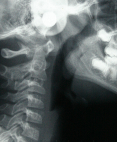 Relación entre ortodoncia y respiración 1
