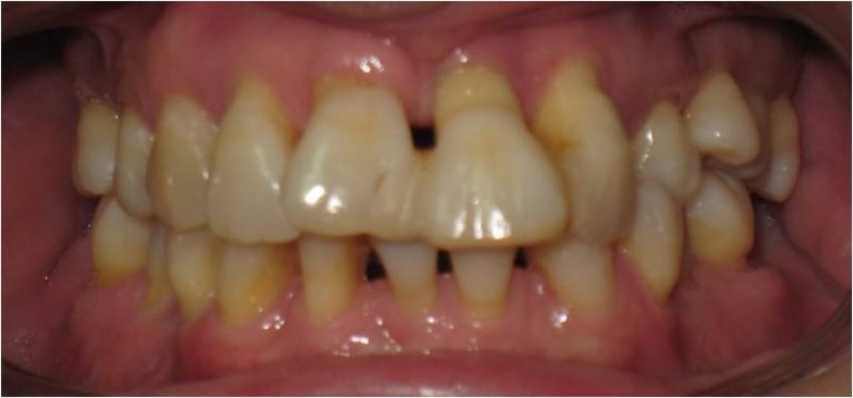 Control periodontal en ortodoncia