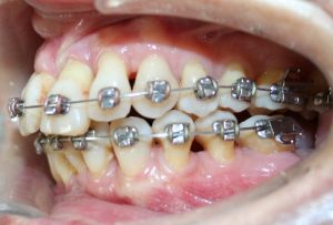 Control periodontal en ortodoncia