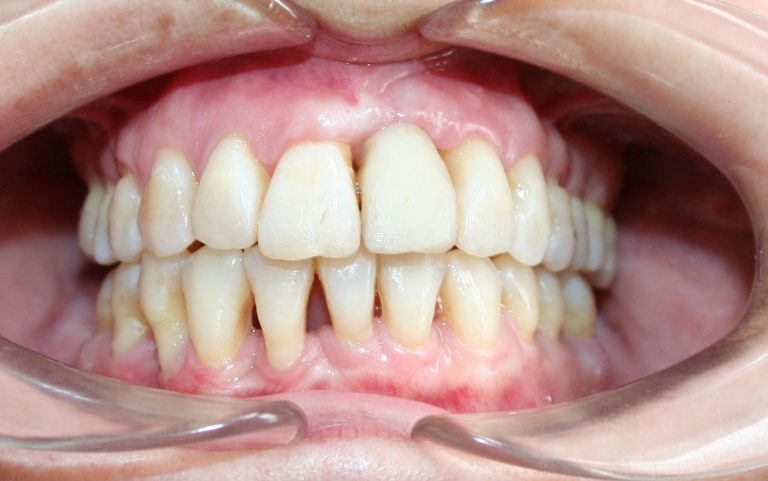 Control periodontal en ortodoncia