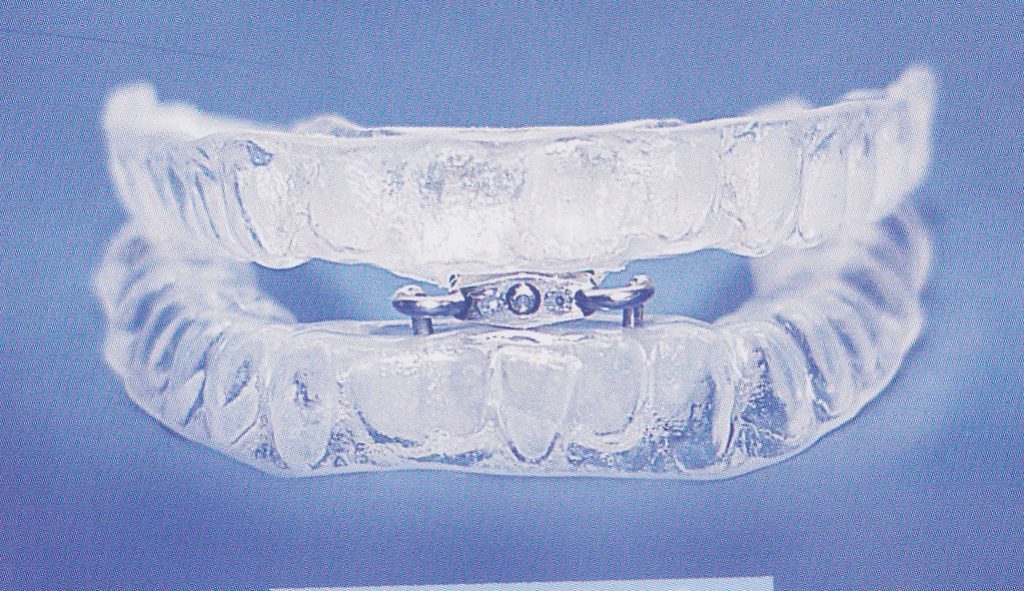 Tratamiento de apnea con propulsores mandibulares