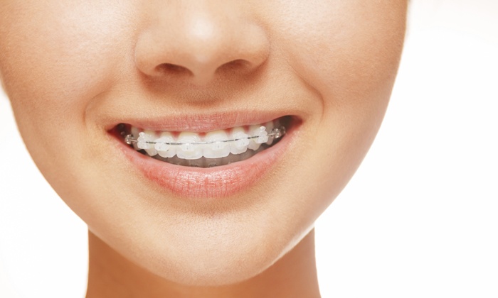 Brackets de zafiro 1