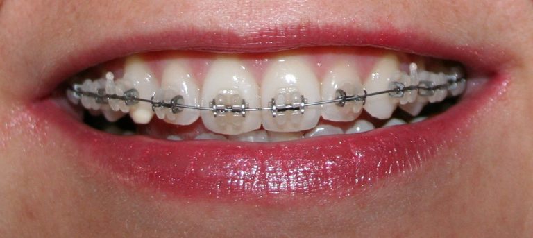 Brackets de zafiro 2